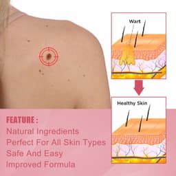 image-Cure Warts Remove Moles Face And Neck Filamentous Warts Body Cleaning Soap