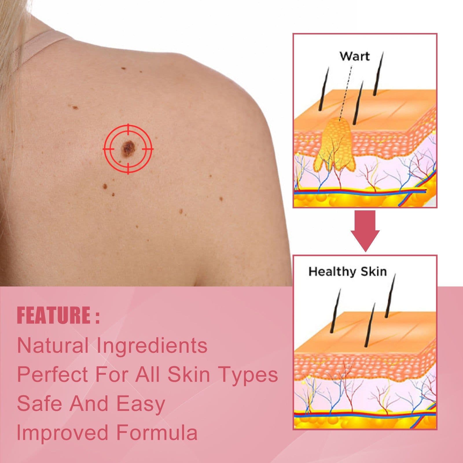 image-Cure Warts Remove Moles Face And Neck Filamentous Warts Body Cleaning Soap
