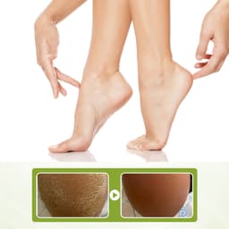 image-Exfoliate Feet Remove Dead Skin And Calluses Heel Elbow And Knee Care Spray