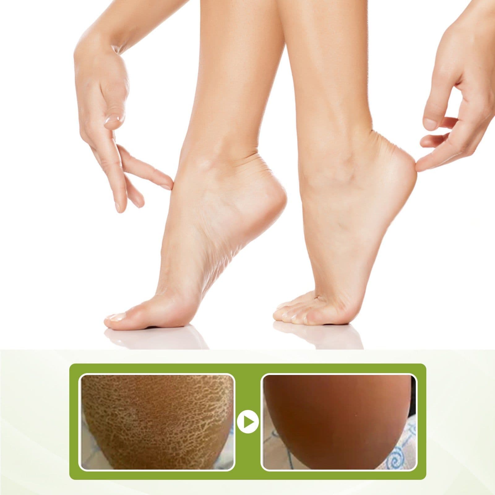 image-Exfoliate Feet Remove Dead Skin And Calluses Heel Elbow And Knee Care Spray