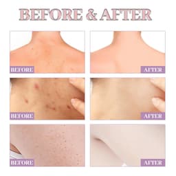 image-Chest Back Cleansing Fade Acne Print Skin Care Ball