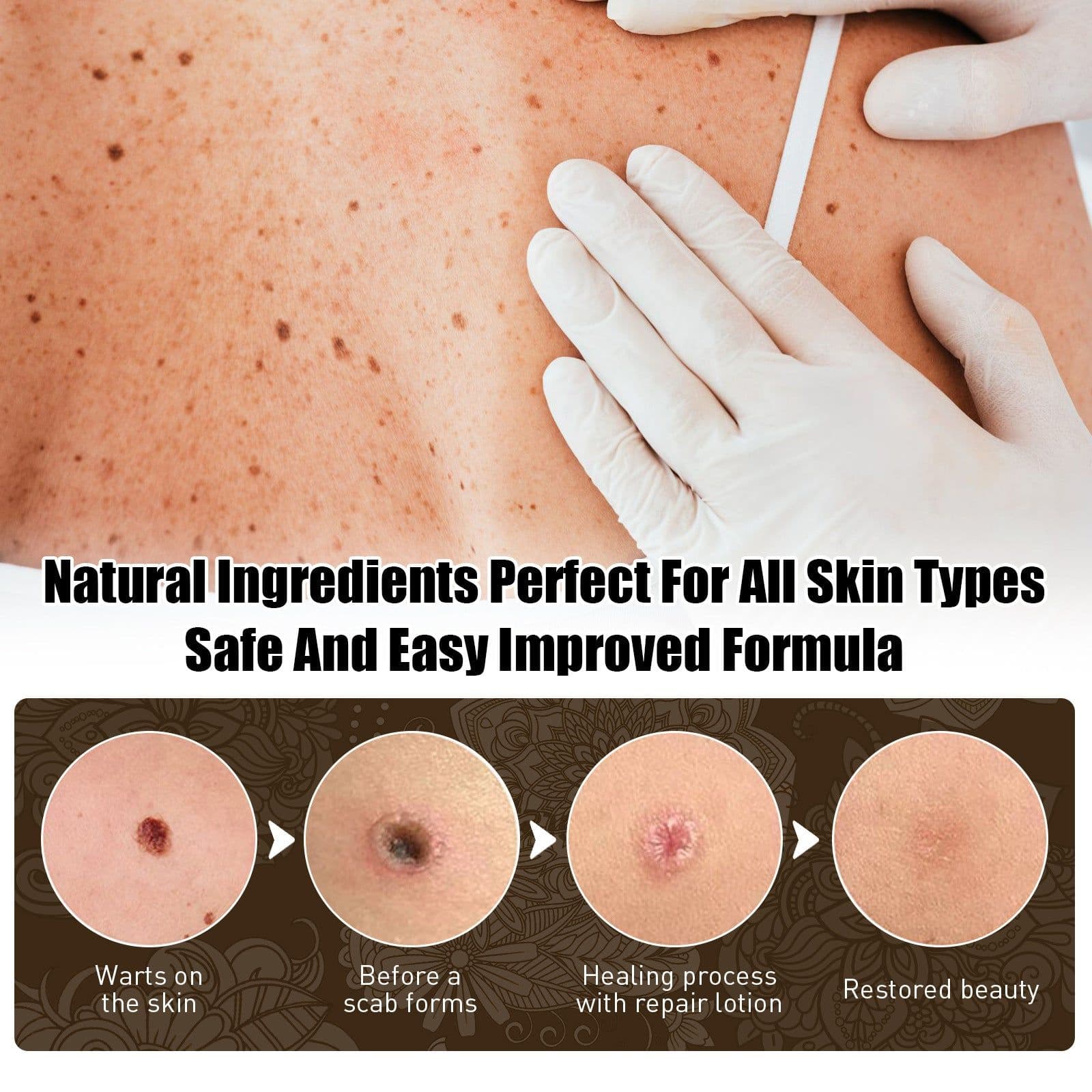 image-Skin Cleansing Black Mole Wart Ointment Hand And Foot Face Armpit Flesh Bump Neck Care Cream
