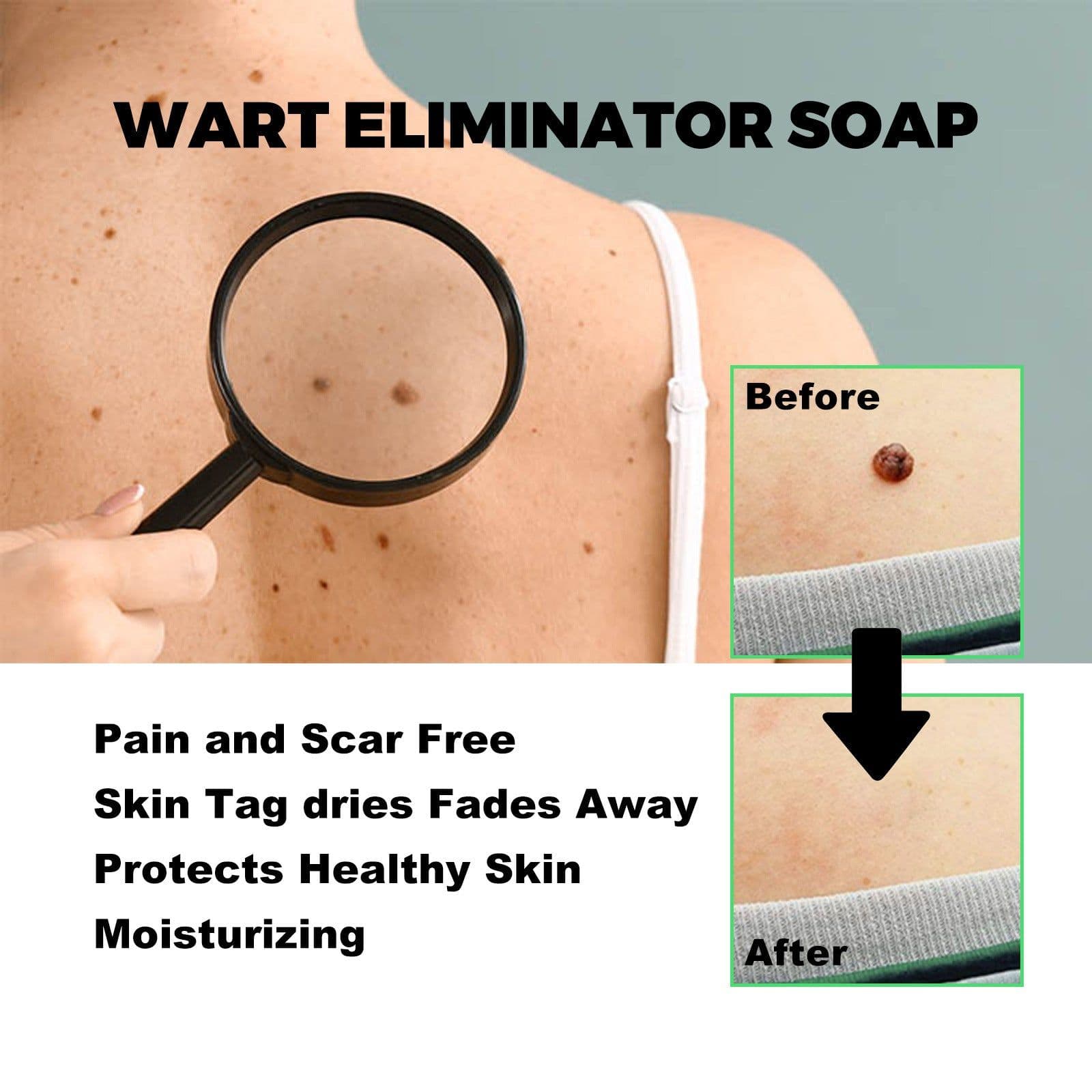 image-South Moon Anti-Wart Soap - Face & Body