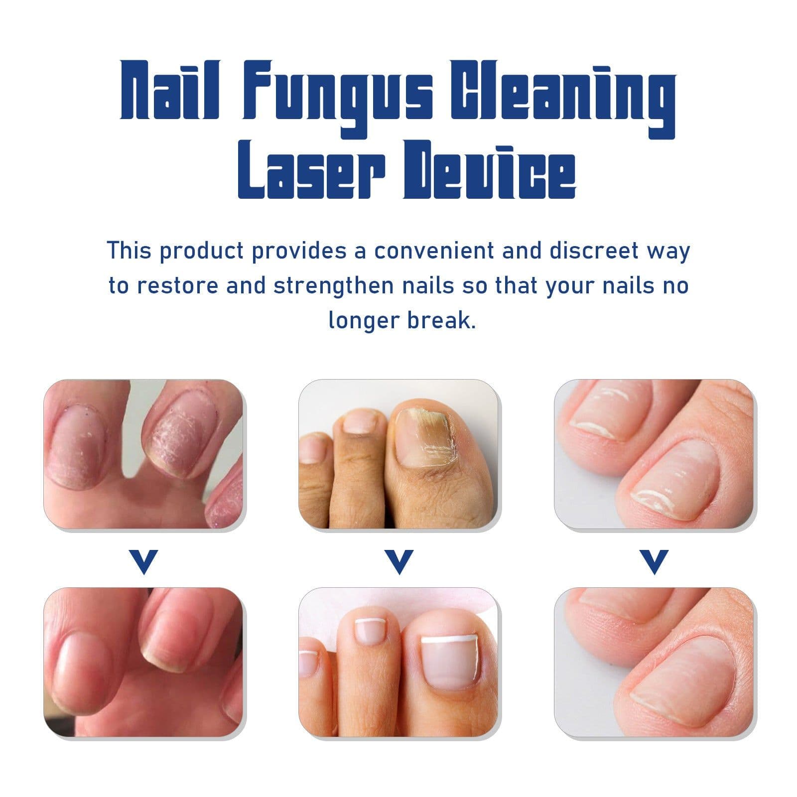 image-EOHOE Nail Care Device Toenail Treatment