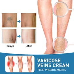 image-OUHOE vein repair cream relieve leg pain massage leg sore varicose pulse health care cream