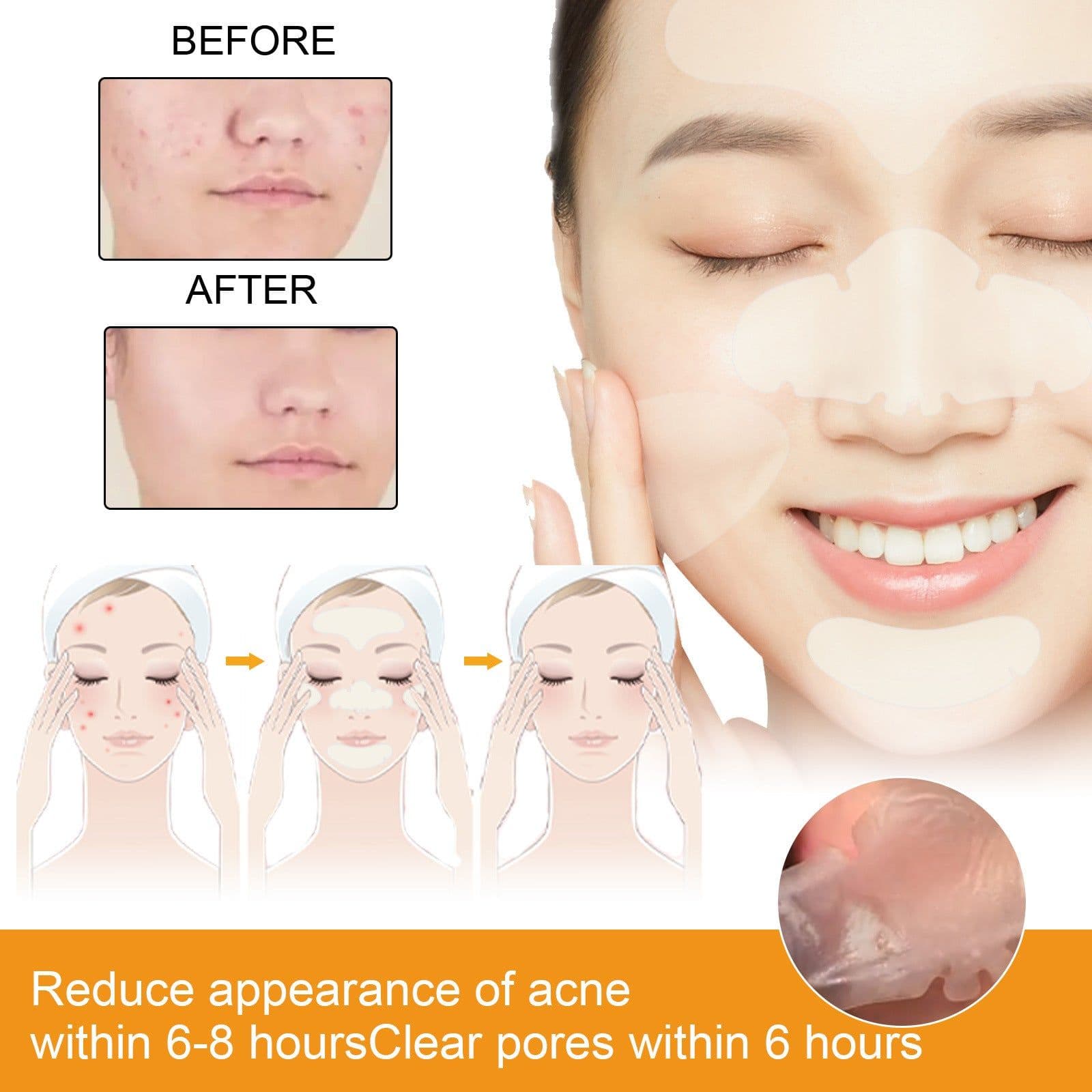 image-EELHOE Hydrogel Acne Patches - Transparent 24pc