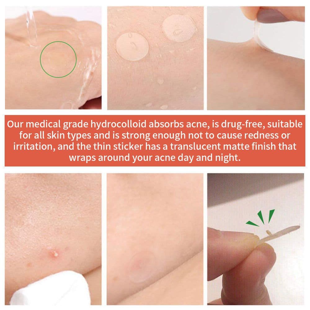 image-Acne Sticker Pimple Patch 72 Count - Invisible Concealer