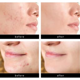 image-Acne Sticker Pimple Patch 72 Count - Invisible Concealer
