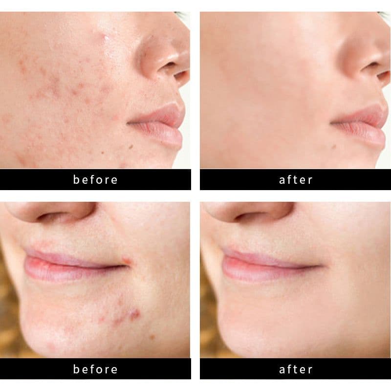 image-Acne Sticker Pimple Patch 72 Count - Invisible Concealer