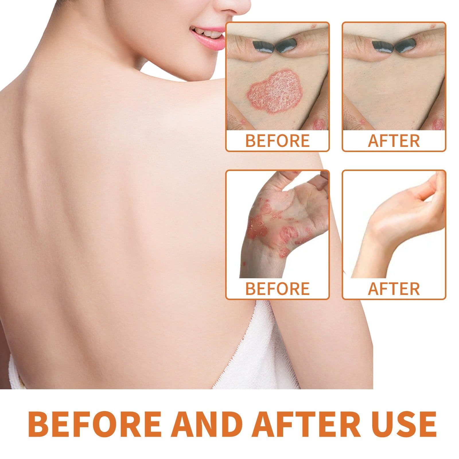 image-WIYUN Bee Venom Psoriasis Cream - Moisturizing