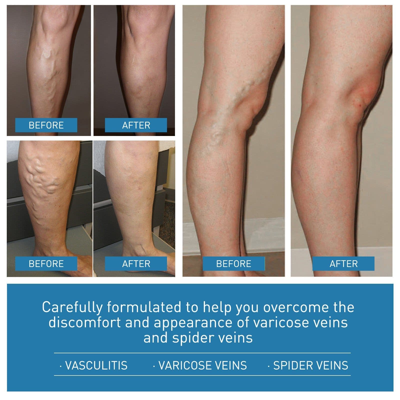 image-OUHOE vein repair cream relieve leg pain massage leg sore varicose pulse health care cream