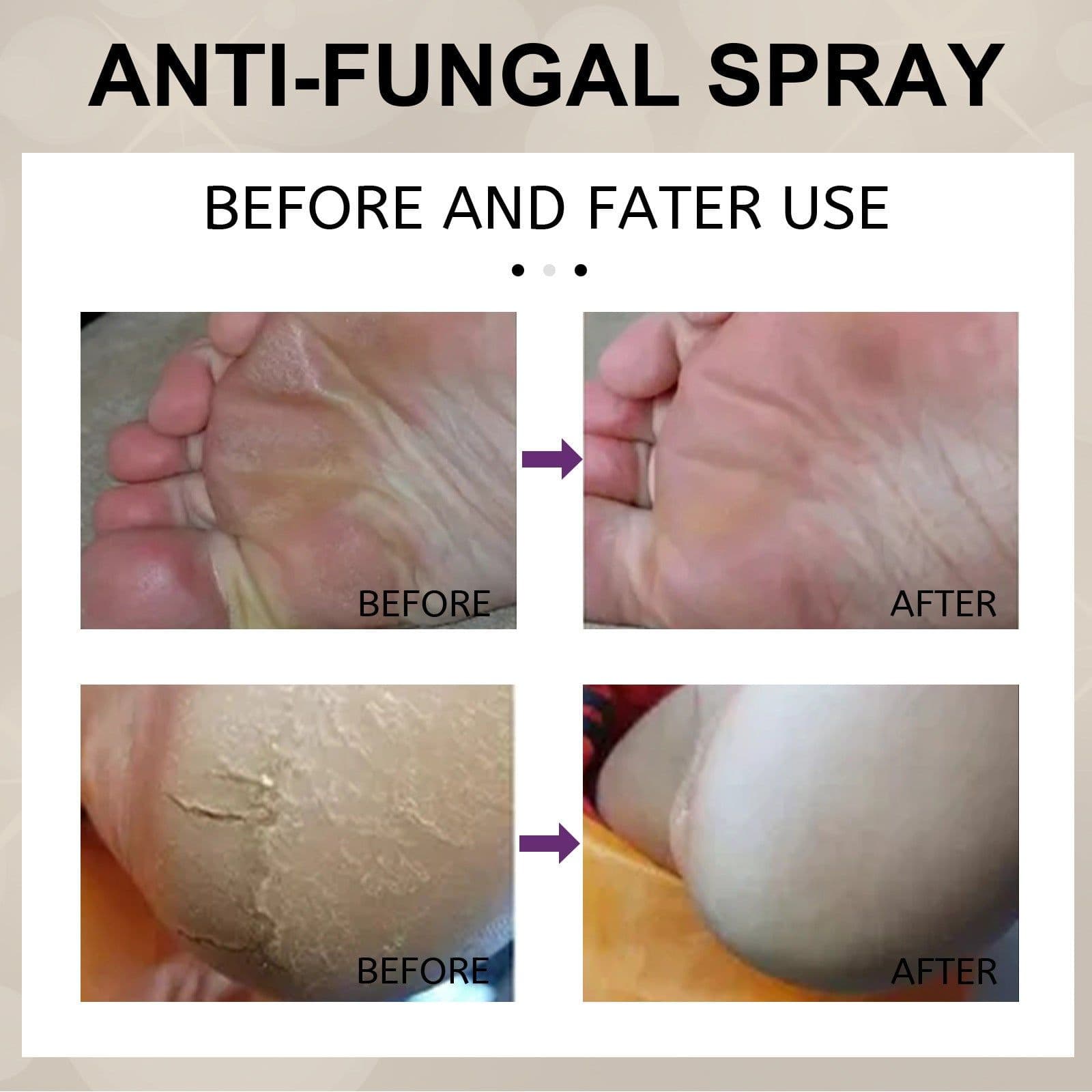 image-Foot Spray - Moisturizing Exfoliating Anti-Itch 30ml