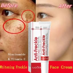 image-Powerful Whitening Freckles Face Cream Dark Spot Corrector Removal Melasma Fade Melanin Pigmentation Brighten Skin Care Products